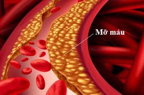 Triglyceride cao gây viêm tụy cấp nguy hiểm đe doạ tính mạng