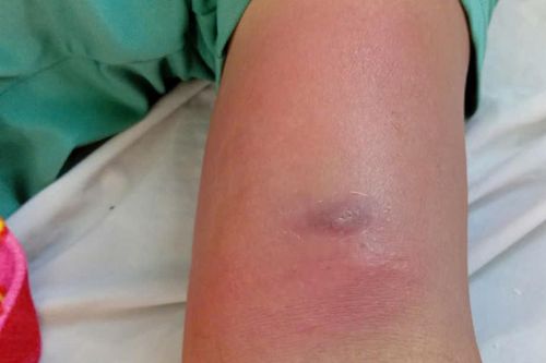 Giun rồng chui dưới da sau nhiều ngày đi rừng uống nước suối