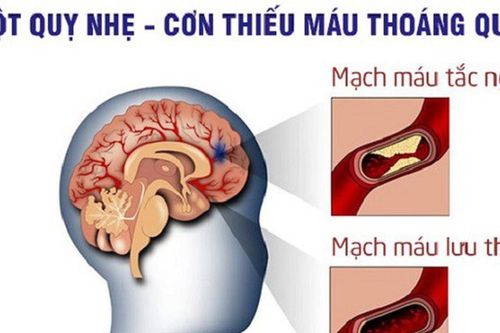 5 dấu hiệu nhận biết sớm cơn thiếu máu não thoáng qua
