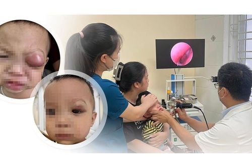 Trẻ 18 tháng tuổi nguy cơ mất thị lực do viêm xoang biến chứng