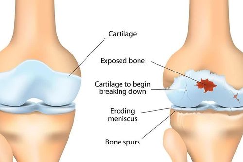 Phát hiện thuốc chống động kinh có thể giúp phục hồi sụn khớp