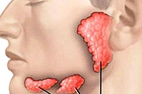 Sưng đau dưới lưỡi, cảnh giác với sỏi tuyến nước bọt