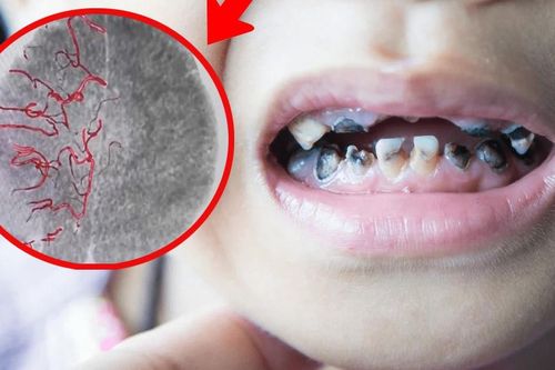 Tự nhổ răng sâu, bé trai 10 tuổi xuất huyết não nghiêm trọng