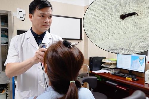 Bắt đỉa sống trong thanh quản người phụ nữ có thói quen uống nước ở suối