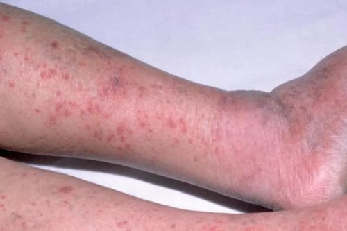 Cục Phòng bệnh thông tin khẩn về chùm 3 ca mắc não mô cầu tại TPHCM