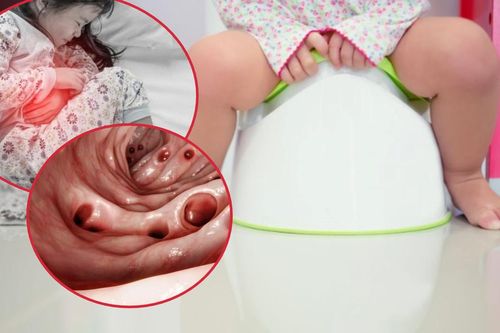 Bé gái đi ngoài ra máu kéo dài, nguyên nhân phía sau khiến gia đình bất ngờ
