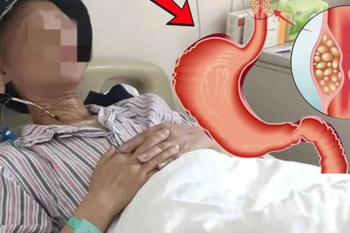 Duy trì 1 thói quen, người đàn ông 53 tuổi phát hiện ung thư từ rất sớm