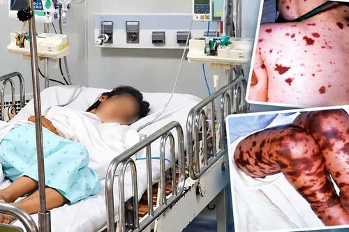 Bệnh não mô cầu có thể gây tử vong trong vài giờ