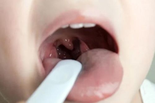 Viêm mũi họng kéo dài ảnh hưởng gì đến sức khỏe trẻ?