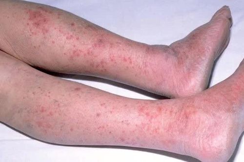 Bệnh não mô cầu có thể gây tử vong trong vài giờ, đừng chờ nổi ban mới đi bệnh viện