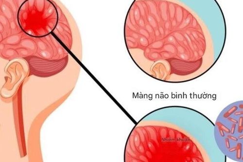 Bệnh não mô cầu có thể gây tử vong nhanh, chuyên gia cảnh báo những dấu hiệu nguy hiểm