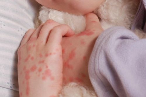 Cảnh báo căn bệnh đe dọa tính mạng chỉ trong vài giờ