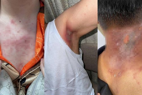 Da đỏ rát, nổi mụn nước: Bác sĩ cảnh báo nguy cơ từ kiến ba khoang