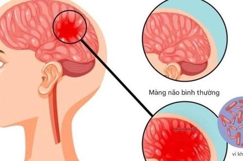 Bệnh não mô cầu xuất hiện trong trường học: Những dấu hiệu phụ huynh không thể bỏ qua