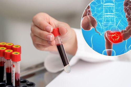 Ung thư đại trực tràng ngày càng trẻ hóa: Những dấu hiệu cảnh báo sớm