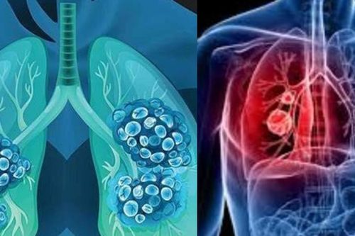 Người đàn ông 68 tuổi phát hiện ung thư phổi di căn từ những dấu hiệu người Việt dễ bỏ qua