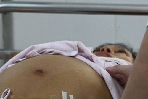 Ngứa ran khắp người nghĩ dị ứng hải sản, hóa ra ung thư gan giai đoạn cuối