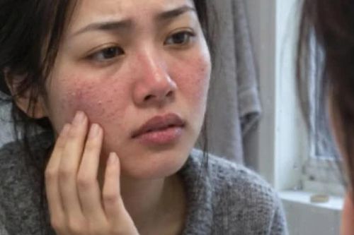 Da nhạy cảm trước gió lạnh: chăm sóc thế nào cho đúng?
