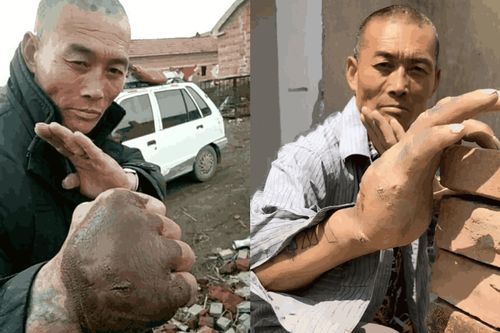 Nông dân Trung Quốc luyện Thiết Sa Chưởng 20 năm, bàn tay biến dạng như quái vật
