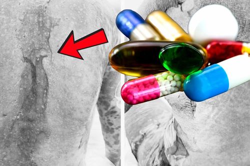 Dùng thuốc trị gout, người bệnh hoại tử da, nguy kịch tính mạng