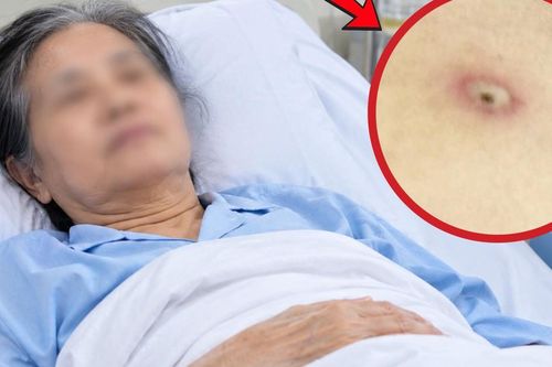 Người phụ nữ 62 tuổi phải cấp cứu chỉ vì 1 vết đốt nhỏ