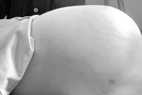 Phẫu thuật thành công khối bướu buồng trứng nặng 15 kg ở bé gái 14 tuổi
