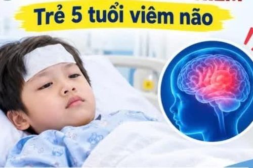 Trẻ 5 tuổi viêm não hoại tử do cúm A: Cảnh giác sốt cao, nói sảng