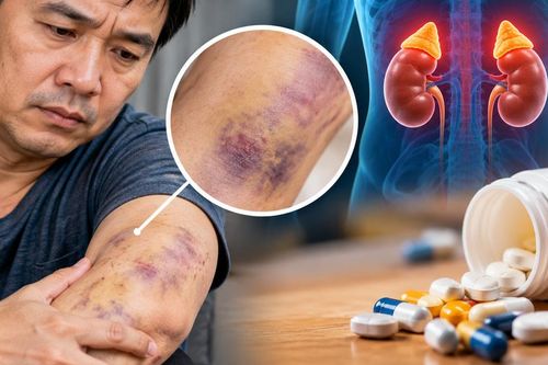 Da mỏng dễ bầm tím, chẩn đoán suy tuyến thượng thận do tự ý dùng thuốc