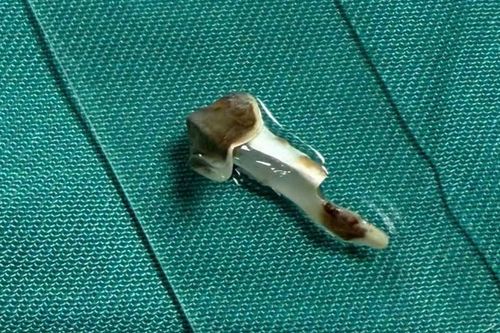 Bé 13 tuổi ho kéo dài hơn 3 năm, bác sĩ phát hiện dị vật nhựa trong phế quản