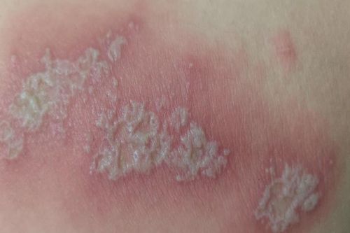 Viêm da tiếp xúc do kiến ba khoang, cách xử trí đúng tránh lan rộng