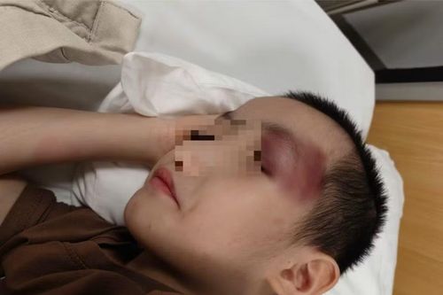 Thông tin mới vụ bé trai 6 tuổi bị chấn thương sọ não khi gửi tại cơ sở can thiệp