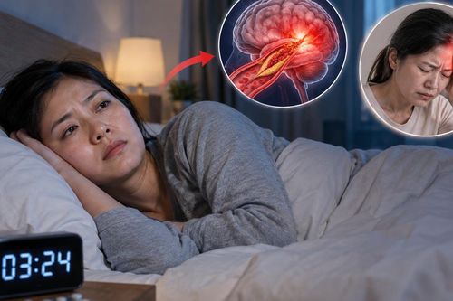 Mất ngủ kéo dài liên quan đến nguy cơ đột quỵ và sức khỏe não bộ