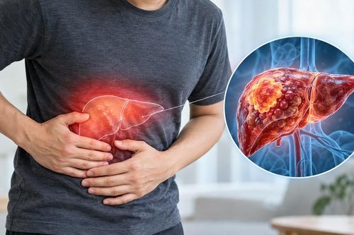 Ung thư gan: Số ca tử vong gần bằng số ca mắc mới