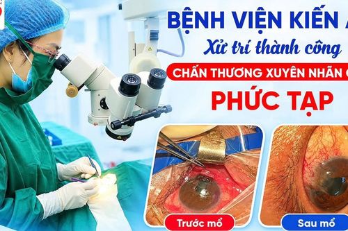 Bảo tồn thị lực cho bệnh nhân bị mảnh bát vỡ đâm xuyên nhãn cầu