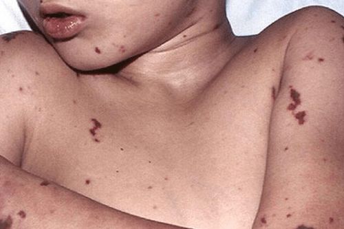 Hiểu đúng về não mô cầu để không bỏ lỡ thời điểm vàng