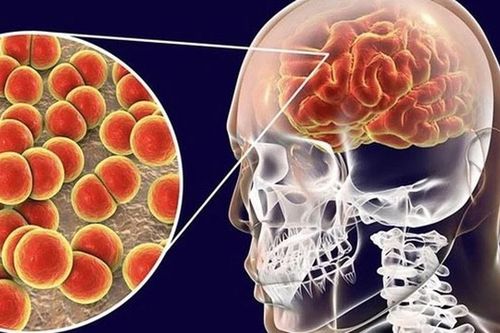 Bệnh do não mô cầu có thể diễn tiến tối cấp: 5 dấu hiệu cha mẹ không nên bỏ qua