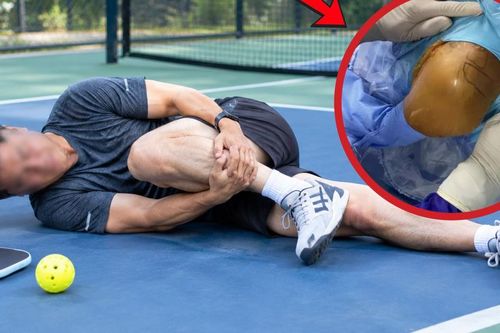 Chơi pickleball, người đàn ông ngoài 40 tuổi bị đứt hoàn toàn gân gót chân