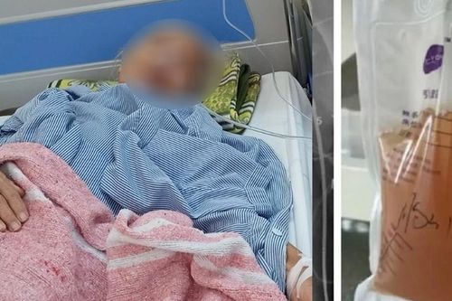 Bác sĩ hút 2,5 lít dịch mỗi ngày từ lồng ngực cụ bà