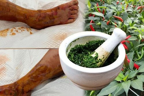 Người phụ nữ 65 tuổi hoại tử chân sau khi đắp lá ớt chữa vết thương