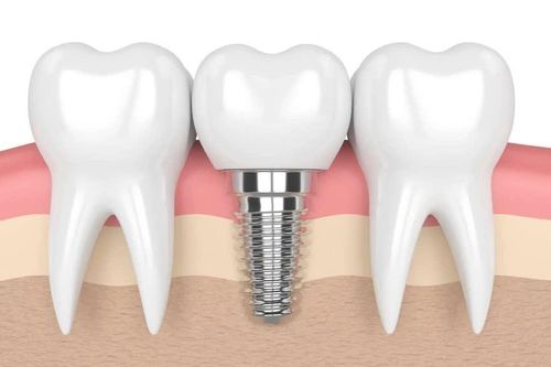 Hạt titan từ răng implant có thể kích hoạt viêm kéo dài