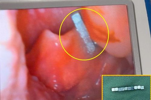 Bé trai gần 4 tuổi nuốt chuỗi nam châm từ đồ chơi xếp hình