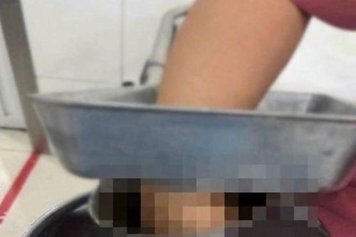 Nữ nhân viên nấu ăn ở trường học bị bàn tay phải cuốn vào máy xay thịt