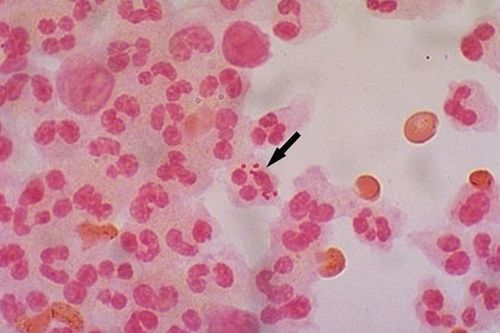 Bệnh có thể diễn tiến nhanh, nhóm tuổi 11-15 chiếm tỷ lệ cao
