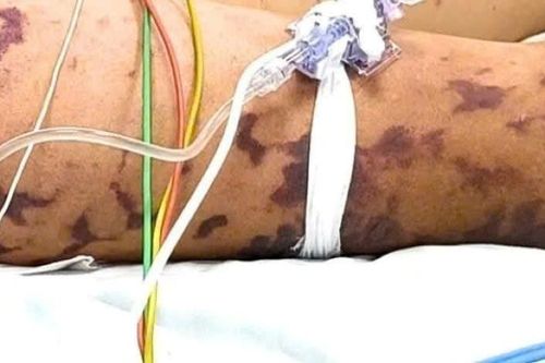 Ghi nhận 2 ca viêm não mô cầu ở Cà Mau, 1 trường hợp tử vong