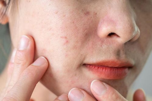 Nâng niu làn da: Cảnh giác với những 'liệu pháp' trên mạng xã hội