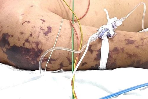 Những điểm chung đáng sợ giữa não mô cầu và liên cầu lợn