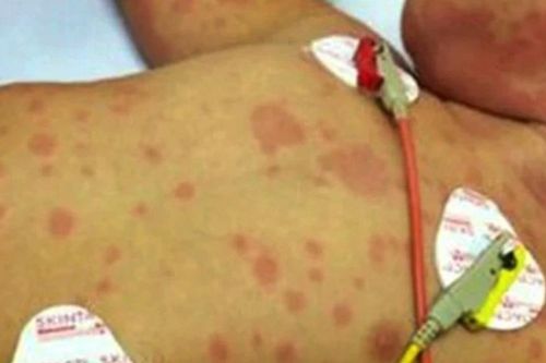 Cà Mau ghi nhận 2 trường hợp tử vong do mắc viêm não mô cầu