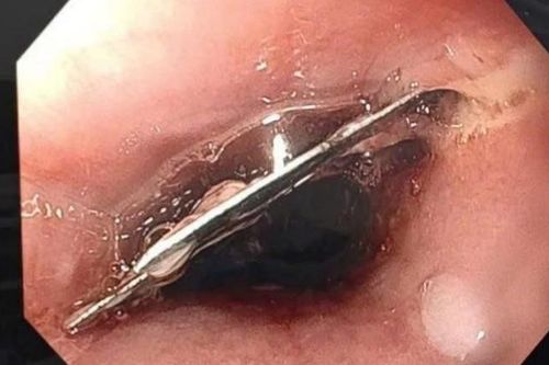 Ăn mì tôm thấy đau họng, đến viện phát hiện lưỡi dao lam trong thực quản