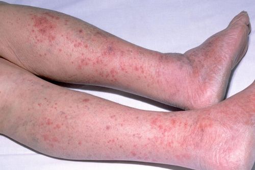 Những biểu hiện điển hình của bệnh não mô cầu