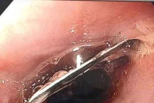 Hy hữu: Người đàn ông nuốt phải lưỡi dao lam khi đang ăn mì tôm